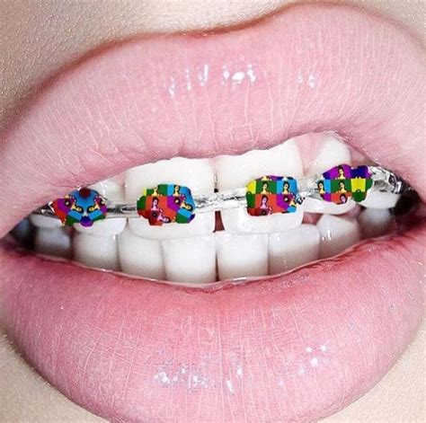 Diy Braces Dental Braces Teeth Braces Dental Care Fake Braces