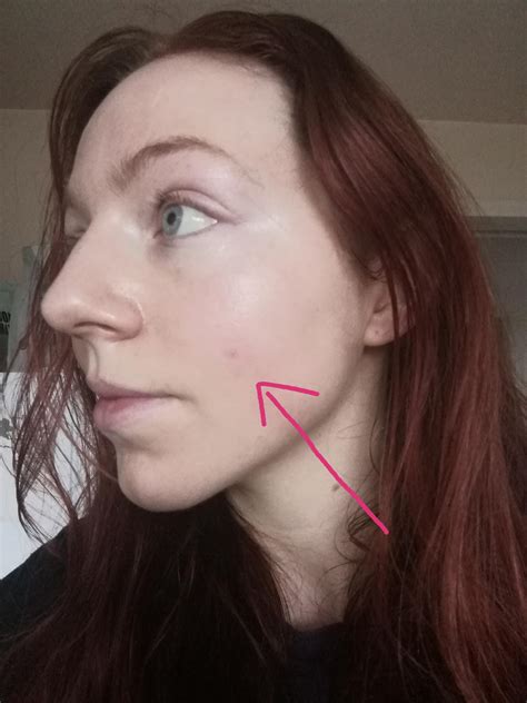 Help Starting To Get Flaky Red Bumps On Cheeks Dont Show Up Well In