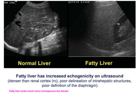 Fatty Liver In Ultrasound Herbs And Food Recipes