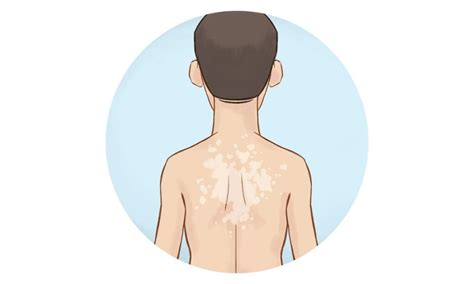 Tinea Versicolor Causes Symptoms And Treatment With Homeopathy