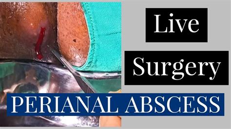 Perianal Abscess Live Surgery Youtube