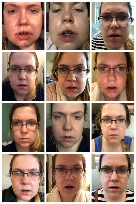 My Double Jaw Surgery Experience The Good The Bad And The Ugly 2