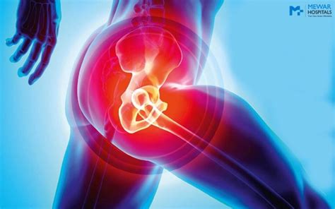 Know All About Partial Hip Replacement In India