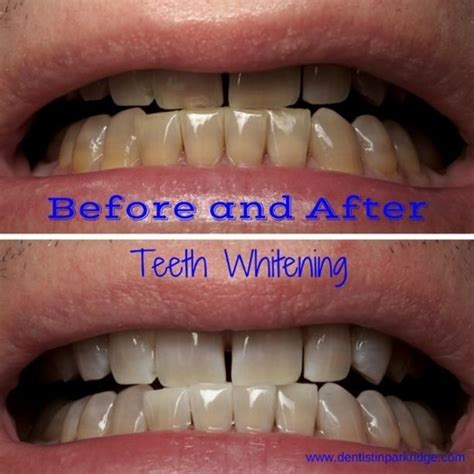That resin will be shaped and shaded to look like your. 87 best Before and After images on Pinterest | Dentists, Park and Parkas