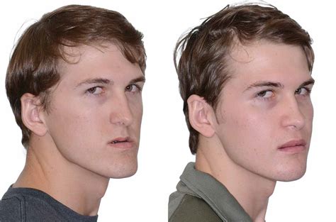 Double Jaw Orthognathic Surgery Corrective Jaw Surgery Dr Antipov