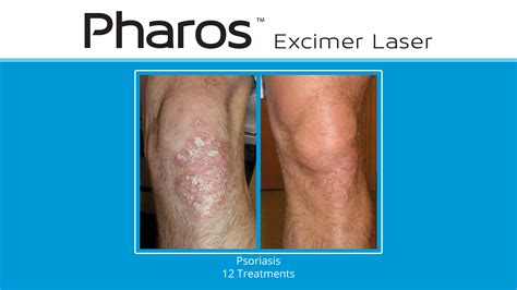 Ra Medical Systems Pharos Excimer Laserpsoriasis Before And Afterknee