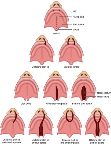 Development Of The Face Nose Palate Cleft Lip Teachme