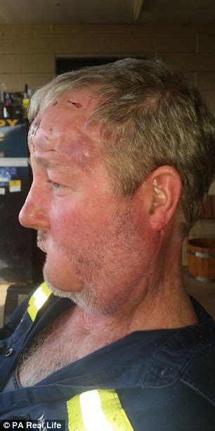 Queensland Mans Cold Sore Was Actually Skin Cancer That Ate Away At