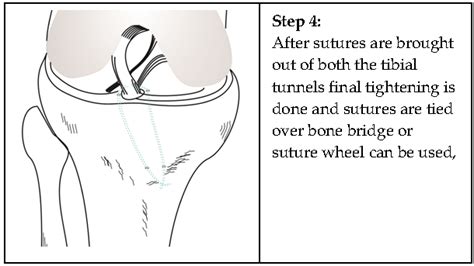 Tibial Spine Avulsion Fractures Current Concepts And Technical Note On