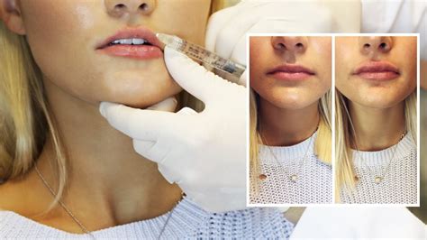 Lip Filler Experience Start To Finish With Syringe Of Juvederm YouTube