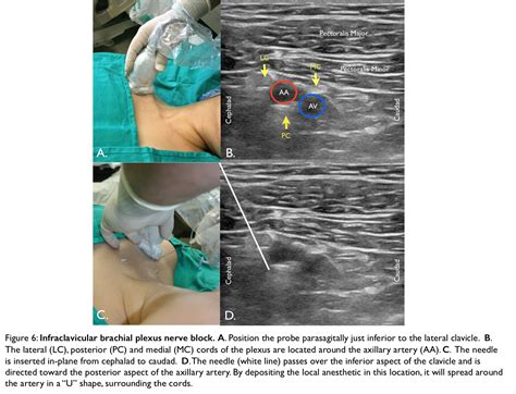 Ultrasound Guided Regional Nerve Blocks In Emergency Medicine