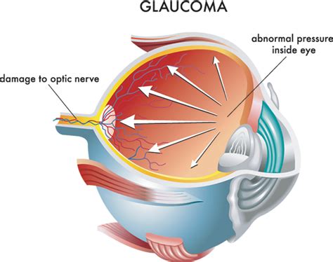 Unfortunately, the pressure within the eyes can change suddenly and. Sparta Glaucoma Treatment | Glaucoma Symptoms in Sparta ...