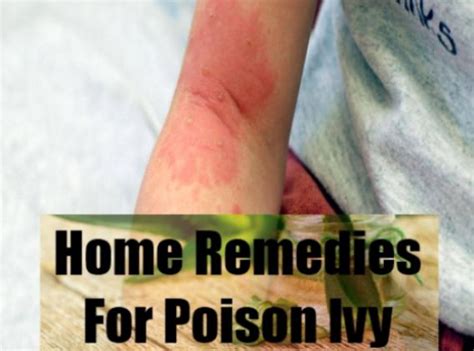 Home Remedies For Poison Ivy Treatment