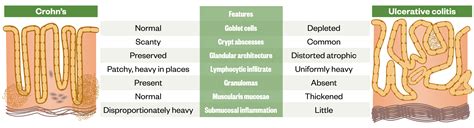 Inflammatory Bowel Disease Symptoms And Diagnosis The Pharmaceutical