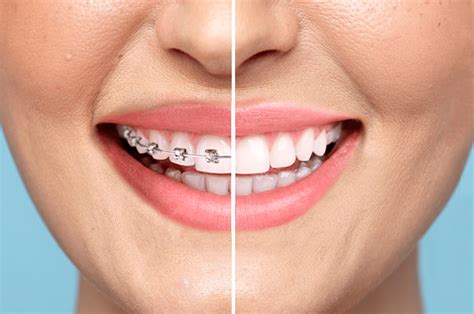 Surprising Facts About Adult Braces You Should Know Clear Smiles