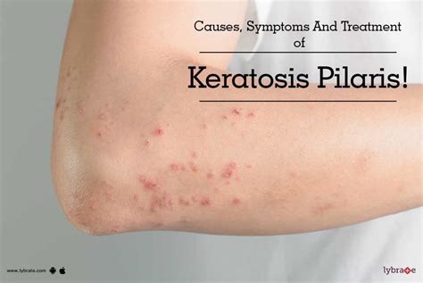 What Causes Keratosis Pilaris In Children How To Trea