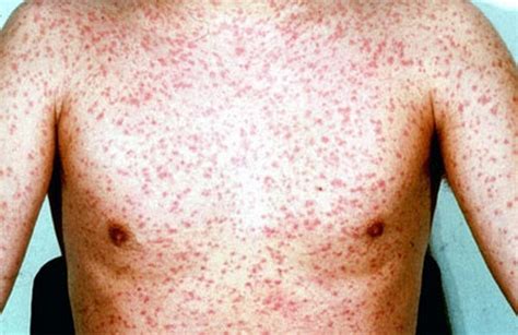 Skin Rashes In Children Pictures Health And Wellness Blog