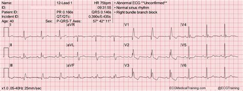How To Calculate Heart Rate From Ecg Sho News