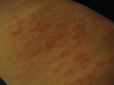 Moderna Vaccine Rash Covid Arm Dermatologists Observe Delayed Skin