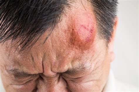 What Causes Lump On Forehead Wound Care Society