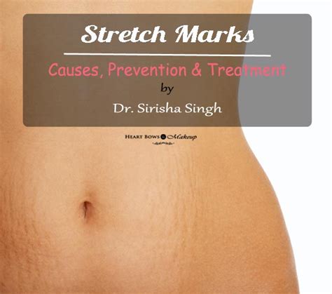 Stretch Marks Causes Prevention Remedies And Treatment Heart Bows