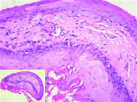 Histopathology Image Showing Multilayered Conjunctival Epithelium With