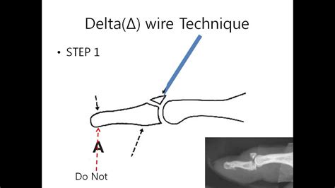 Delta Wire Technique Bony Mallet Finger Youtube