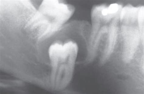 Dentigerous Cyst Inbde Oral Pathology Mnemonics Rememberology