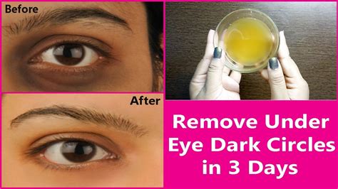Remove Under Eye Dark Circles In 3 Days 100 Effective Natural Remedy