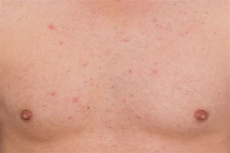 How To Get Rid Of Chest Acne