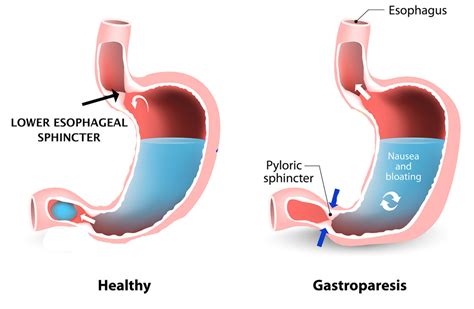 The Importance Of The Sphincters In Larnygopharyngeal Reflux Disease