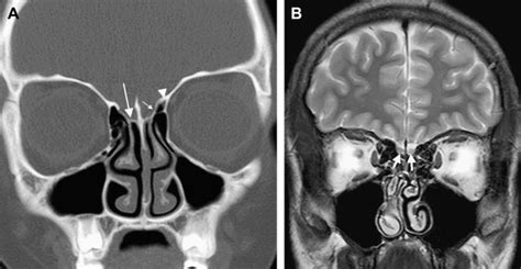 Imaging Of The Anterior Skull Base Radiology Key