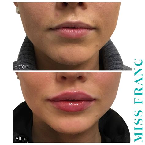 this is our clients second visit with a few months in between 1ml botox lips facial