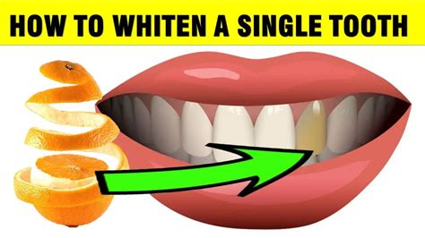Tooth Discoloration Causes And Home Remedies Epic Natural Health