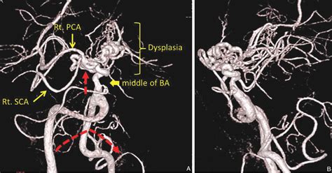 PDF Agenesis Of The Left Internal Carotid Artery In The Right Aortic