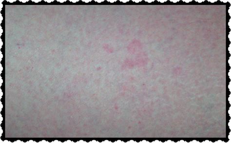 What Do Bed Bug Bites Look Like Hubpages