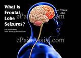 Nocturnal Frontal Lobe Epilepsy Treatment Images
