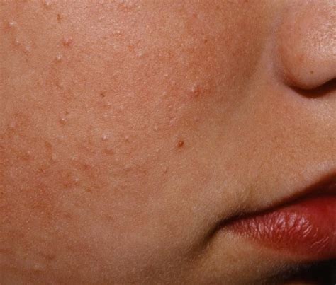 Keratosis Pilaris Tiny Bumps On Face Allergic Reaction Best Anti Aging