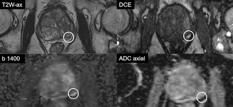 Europe Achieves Growing Consensus On Prostate Mri Scan For Life