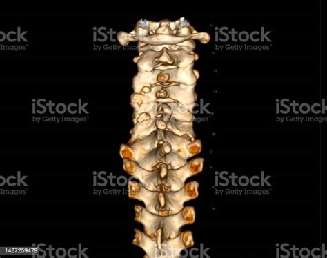 Ct Scan Of Cspine Or Cervical Spine 3d Rendering Stock Photo Download