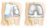 Pictures of Side Incision Knee Replacement Surgery