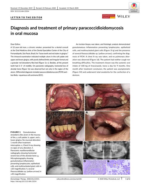 Pdf Diagnosis And Treatment Of Primary Paracoccidioidomycosis In Oral
