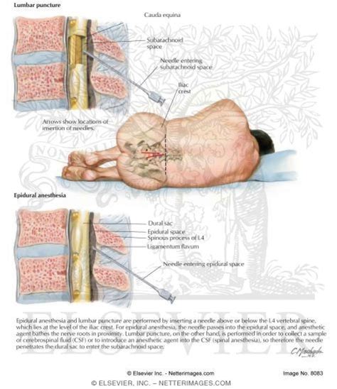Lumbar Puncture Anatomical Landmarks