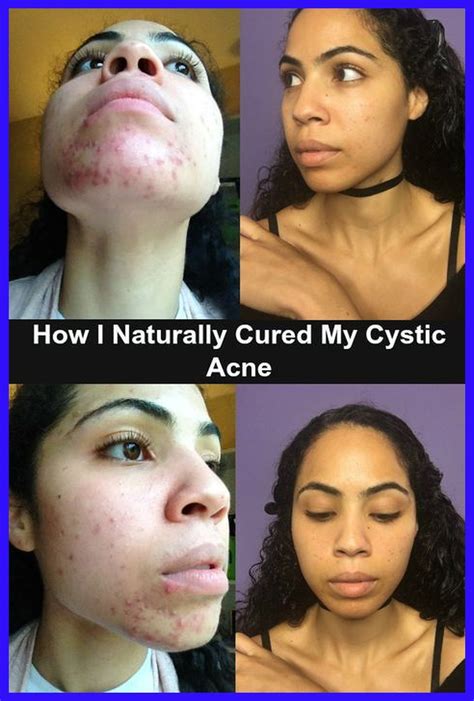 Cystic Acne On Chin Chin Acne Causes Hormonal Acne Supplements