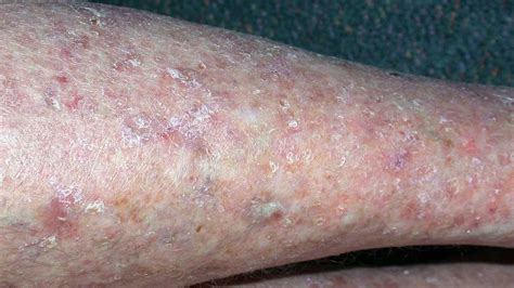 Cellulitis Causes Symptoms Diagnosis And Treatment Youtube
