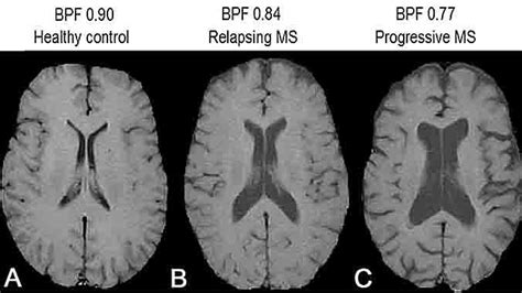 000 patients with multiple sclerosis in the united states.3 multiple sclerosis typically begins in cd figure 1. MRI For Multiple Sclerosis