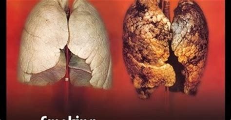 How can i get my lungs healthy again? Smoking is Bad for Lung ~ NATURAL HEALTHY