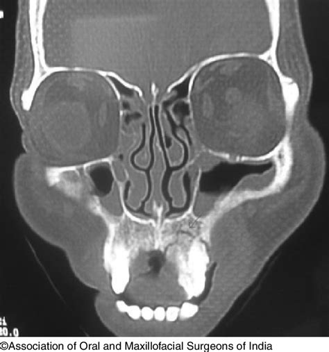 4 Coronal CT Image Showing Left Maxillary High Dentoalveolar Fracture