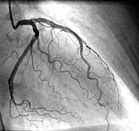 5 Reasons To Get A Coronary Angiogram Cardiac Catheterization Heart