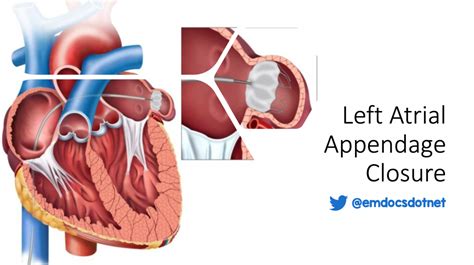 EmDOCs Net Emergency Medicine EducationLeft Atrial Appendage Closure Procedure Basics